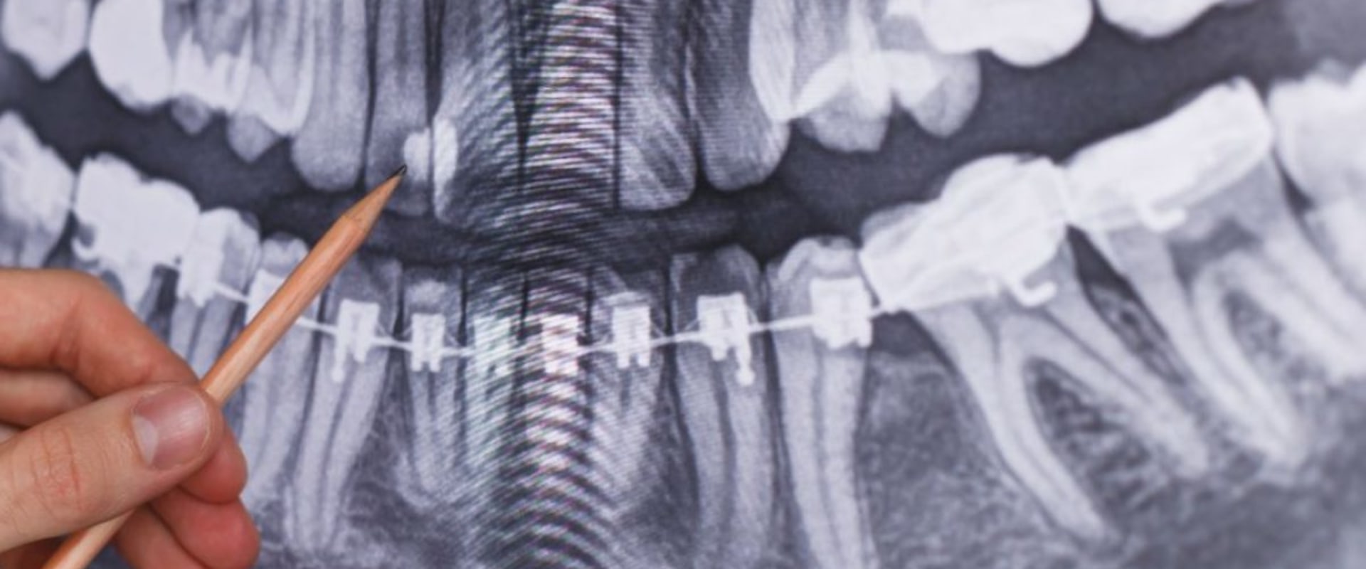 What Are The Different Types Of Dental X-rays?