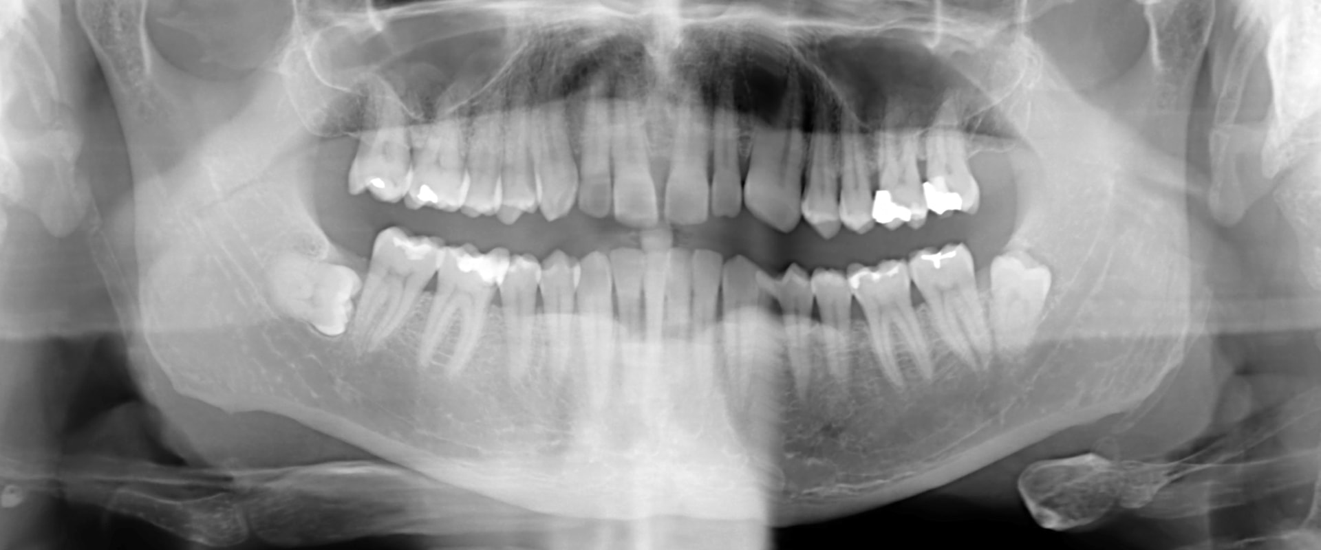 Are dental x rays dangerous?