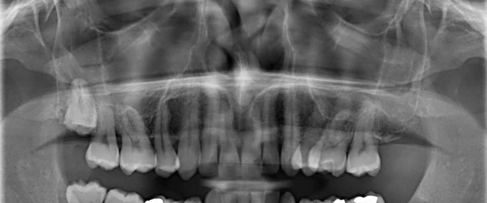 can-dental-x-rays-be-harmful