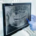 Navigating Your Child's Orthodontic Care: The Importance Of Dental X-Rays In Summerville